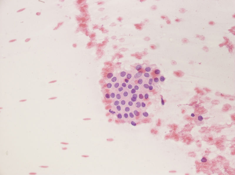 女性，28岁，左甲状腺穿刺涂片图2