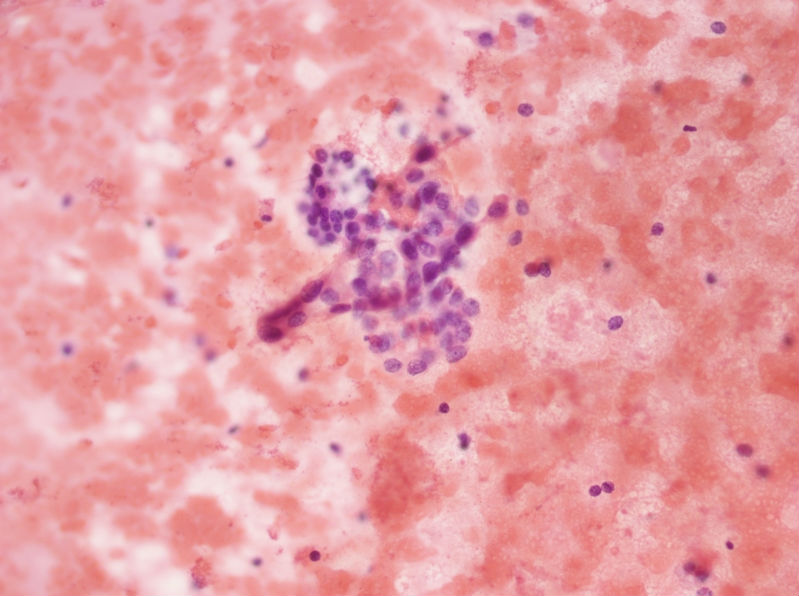 女性,28岁,左甲状腺穿刺涂片图3 女性,28岁,左甲状腺穿刺涂片图3