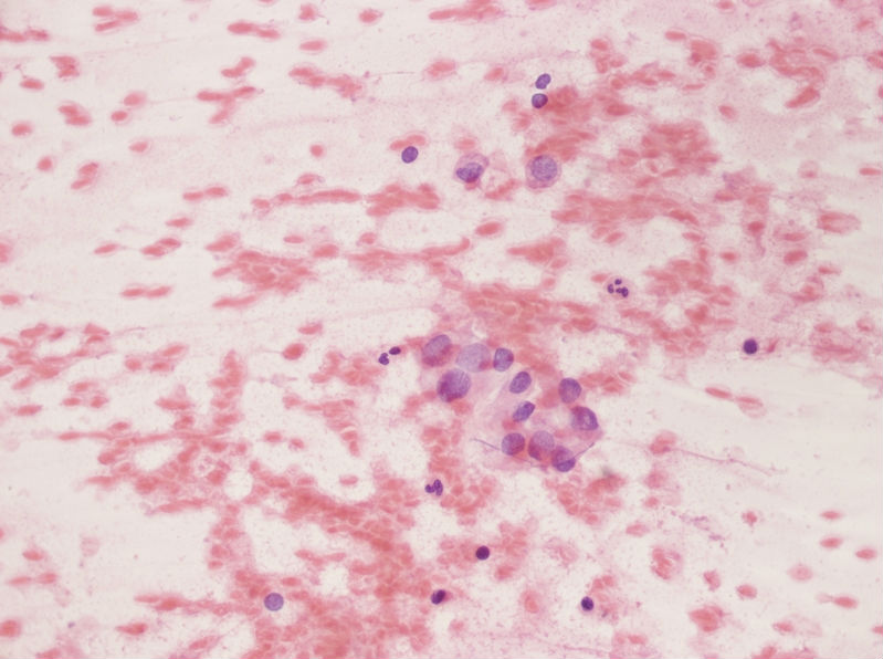 女性，28岁，左甲状腺穿刺涂片图4