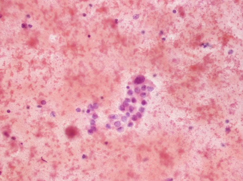 女性,28岁,左甲状腺穿刺涂片图5 女性,28岁,左甲状腺穿刺涂片图5