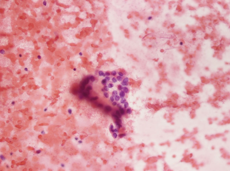 女性，28岁，左甲状腺穿刺涂片图6