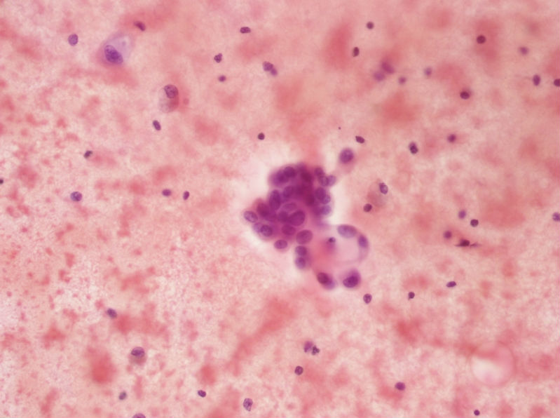 女性,28岁,左甲状腺穿刺涂片图7 女性,28岁,左甲状腺穿刺涂片图7