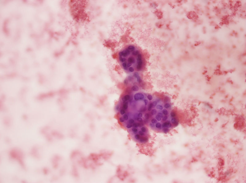 女性,28岁,左甲状腺穿刺涂片图8 女性,28岁,左甲状腺穿刺涂片图8