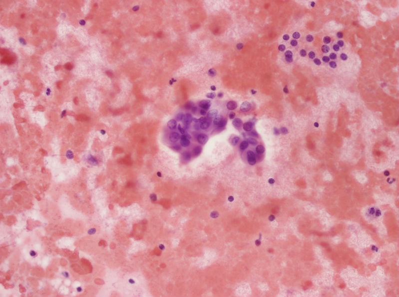 女性,28岁,左甲状腺穿刺涂片图9 女性,28岁,左甲状腺穿刺涂片图9