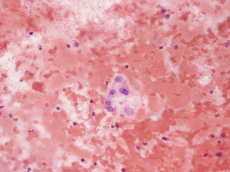 女性,28岁,左甲状腺穿刺涂片图10 女性,28岁,左甲状腺穿刺涂片图10