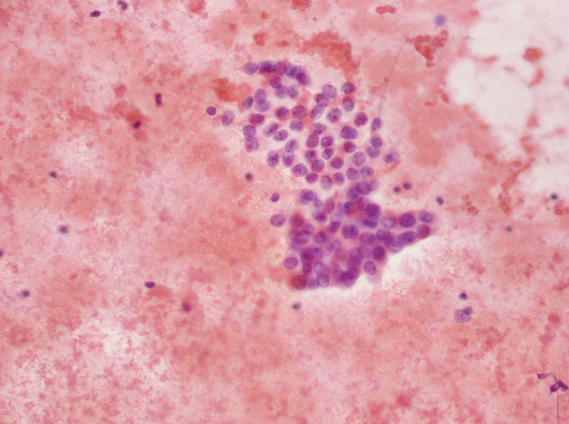 女性,28岁,左甲状腺穿刺涂片图11 女性,28岁,左甲状腺穿刺涂片图11