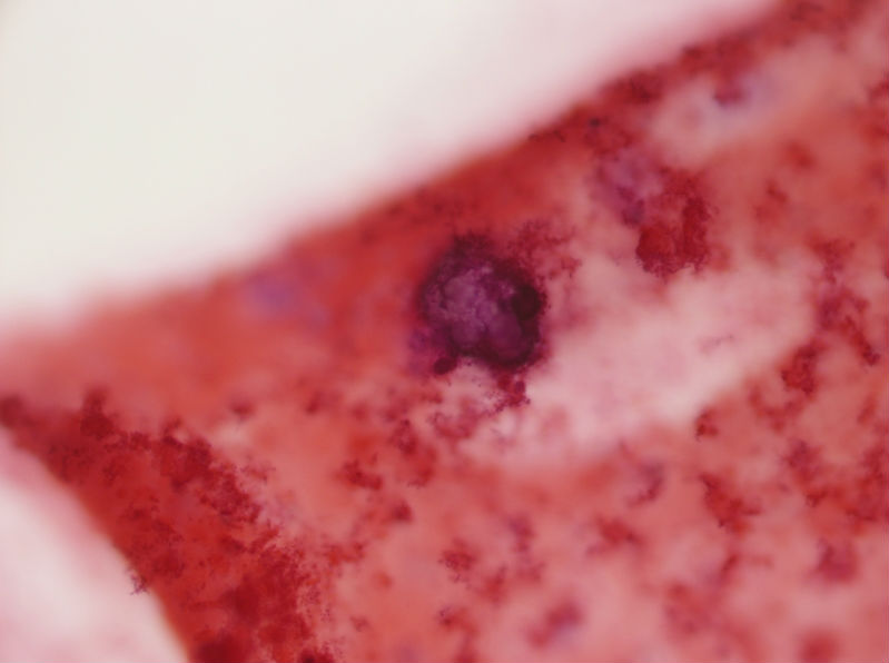 女性，28岁，左甲状腺穿刺涂片图12