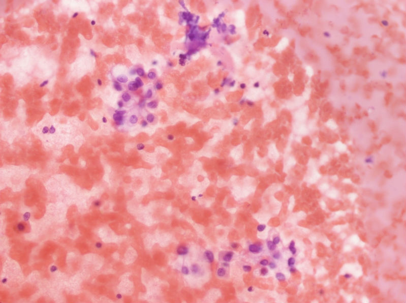 女性，28岁，左甲状腺穿刺涂片图13