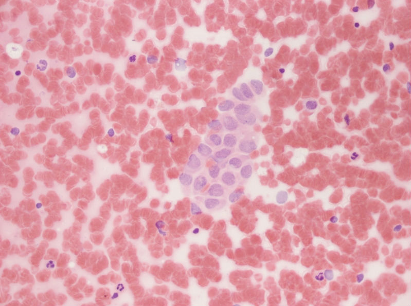 女性,28岁,左甲状腺穿刺涂片图14 女性,28岁,左甲状腺穿刺涂片图14