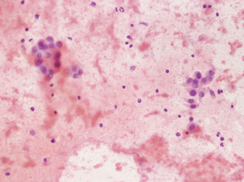 女性,28岁,左甲状腺穿刺涂片图15 女性,28岁,左甲状腺穿刺涂片图15