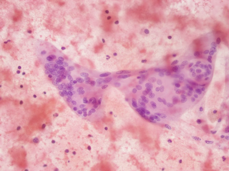 女性，28岁，左甲状腺穿刺涂片图16