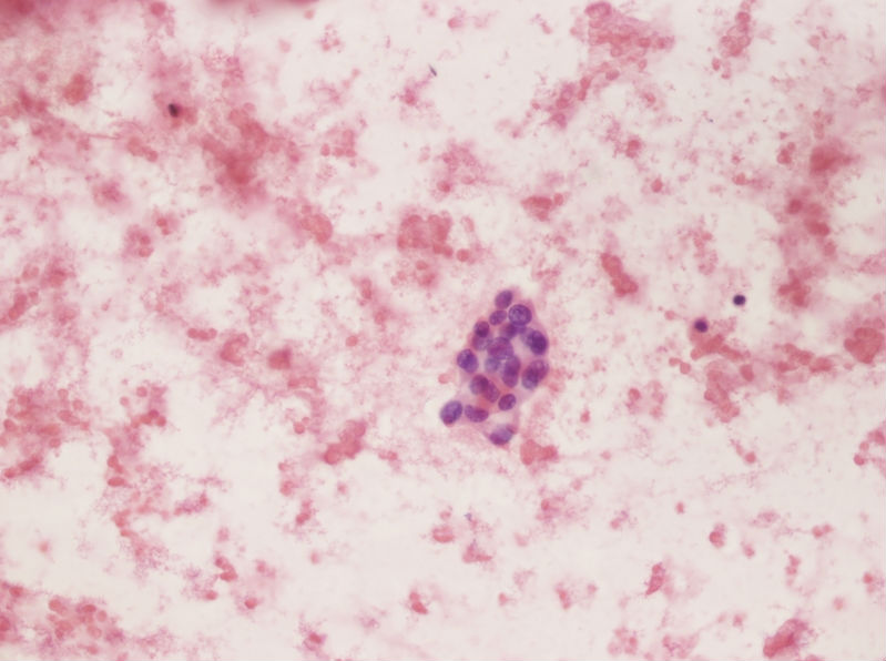 女性，28岁，左甲状腺穿刺涂片图17