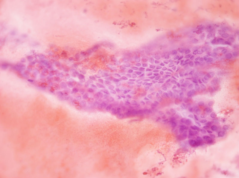 女性,28岁,左甲状腺穿刺涂片图18 女性,28岁,左甲状腺穿刺涂片图18