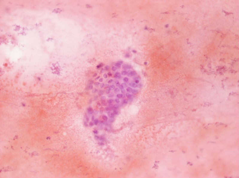 女性,28岁,左甲状腺穿刺涂片图19 女性,28岁,左甲状腺穿刺涂片图19