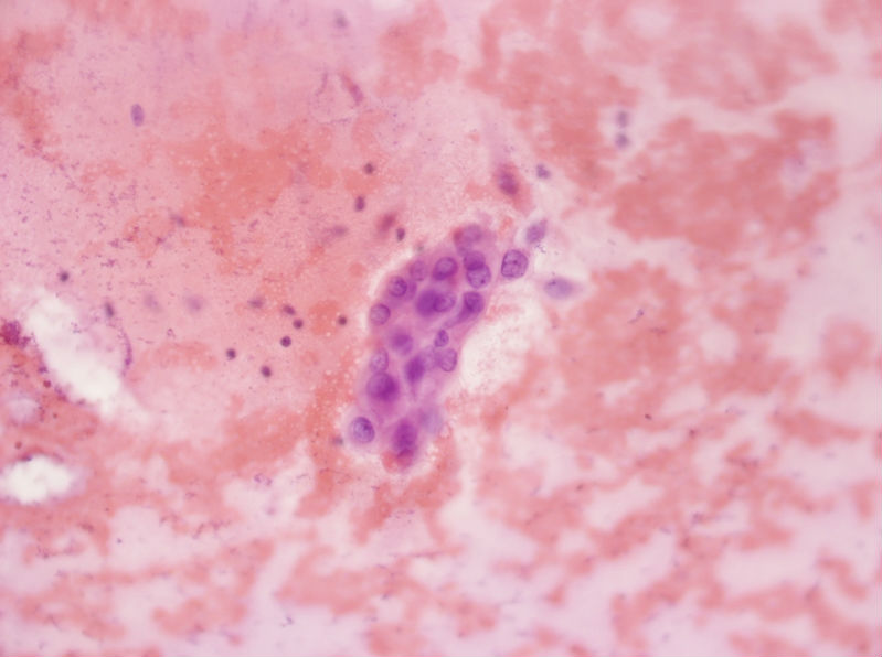 女性,28岁,左甲状腺穿刺涂片图20 女性,28岁,左甲状腺穿刺涂片图20