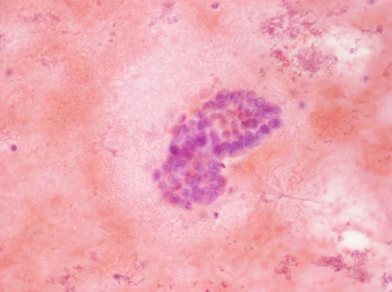 女性,28岁,左甲状腺穿刺涂片图21 女性,28岁,左甲状腺穿刺涂片图21