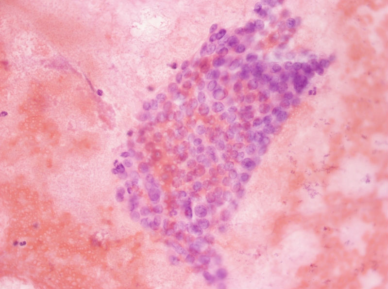 女性，28岁，左甲状腺穿刺涂片图22