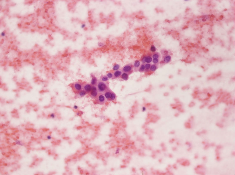 女性，28岁，左甲状腺穿刺涂片图23