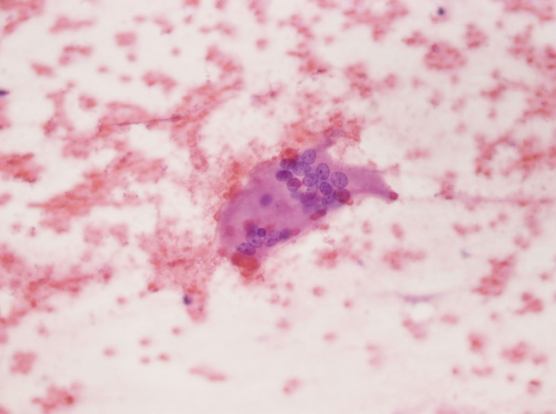 女性，28岁，左甲状腺穿刺涂片图24