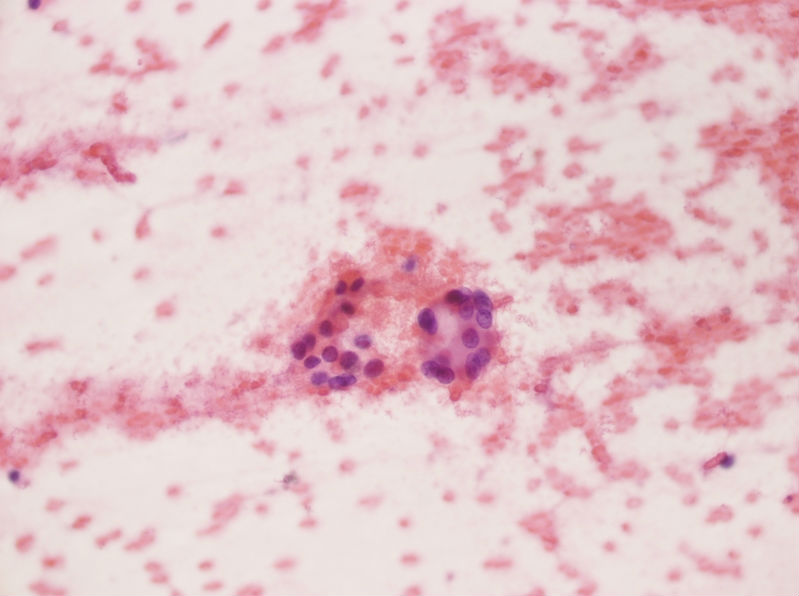 女性,28岁,左甲状腺穿刺涂片图25 女性,28岁,左甲状腺穿刺涂片图25