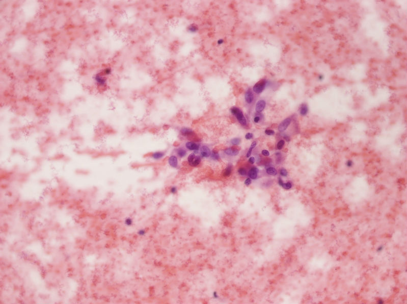 女性,28岁,左甲状腺穿刺涂片图26 女性,28岁,左甲状腺穿刺涂片图26