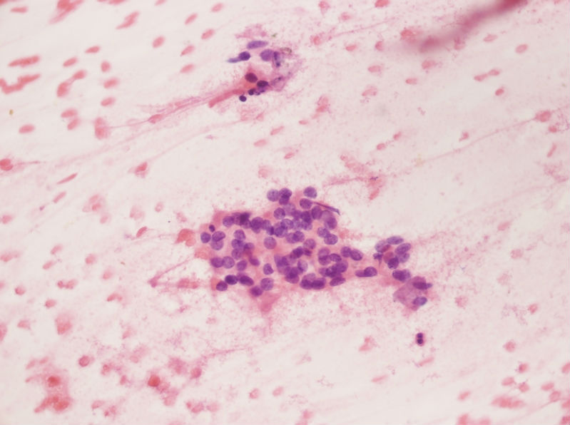 女性,28岁,左甲状腺穿刺涂片图27 女性,28岁,左甲状腺穿刺涂片图27