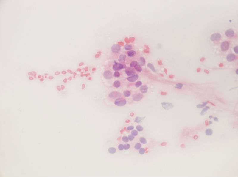 女性,28岁,左甲状腺穿刺涂片图28 女性,28岁,左甲状腺穿刺涂片图28