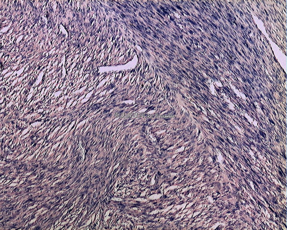 左大腿内侧肿物图1