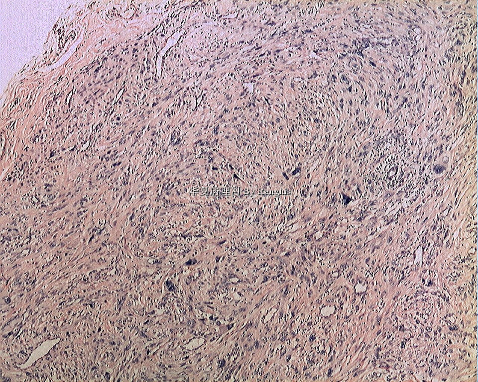 左大腿内侧肿物图2