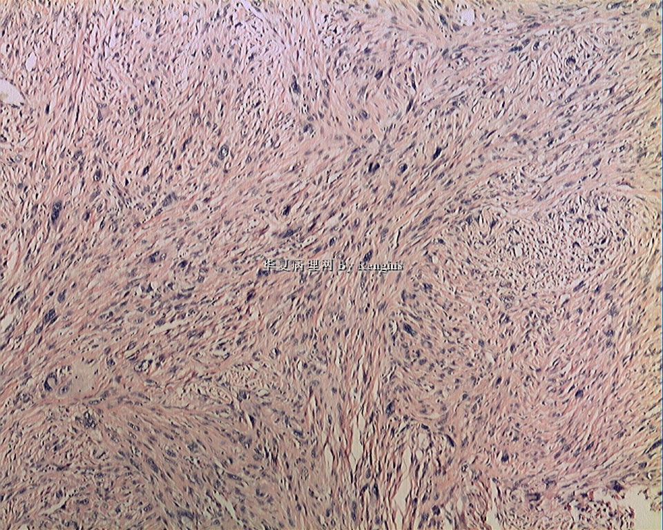 左大腿内侧肿物图3