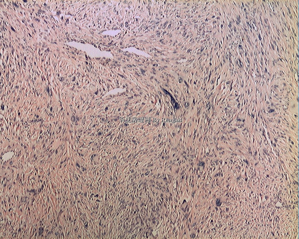 左大腿内侧肿物图4