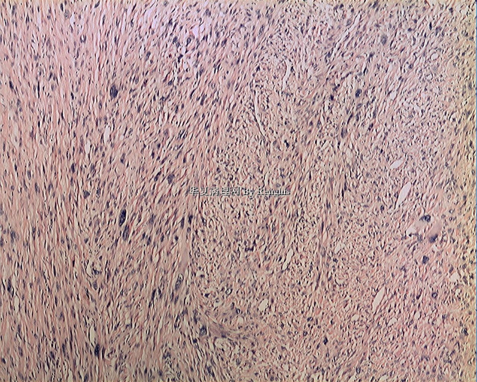 左大腿内侧肿物图5