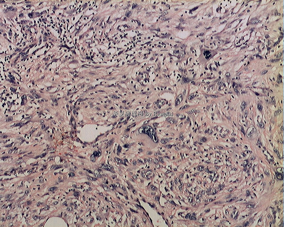 左大腿内侧肿物图6