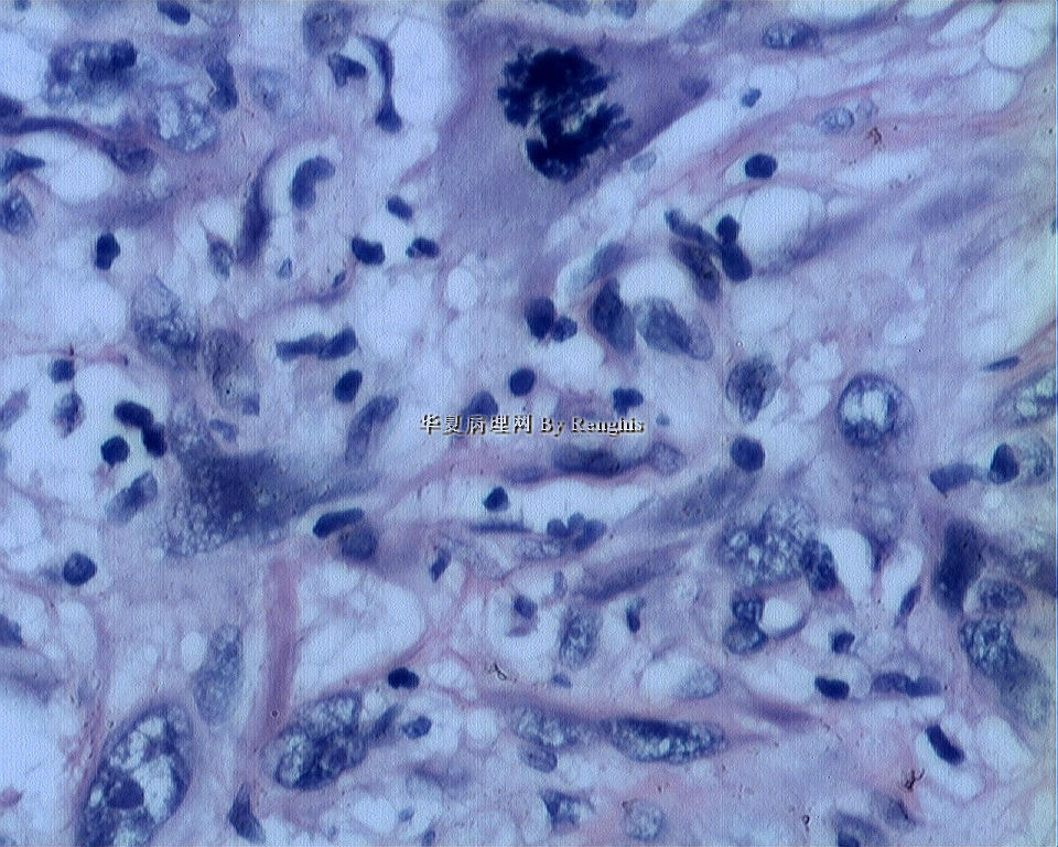 左大腿内侧肿物图7