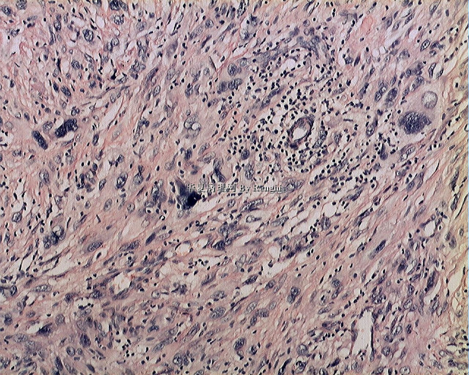 左大腿内侧肿物图8