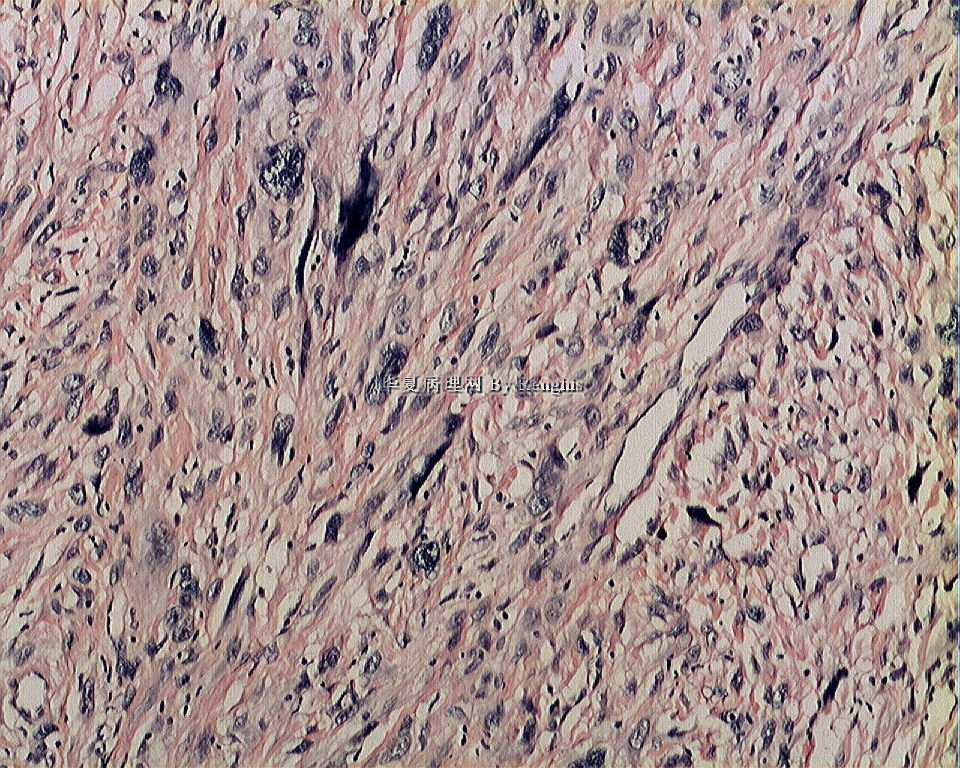 左大腿内侧肿物图9