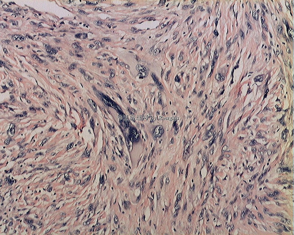 左大腿内侧肿物图10