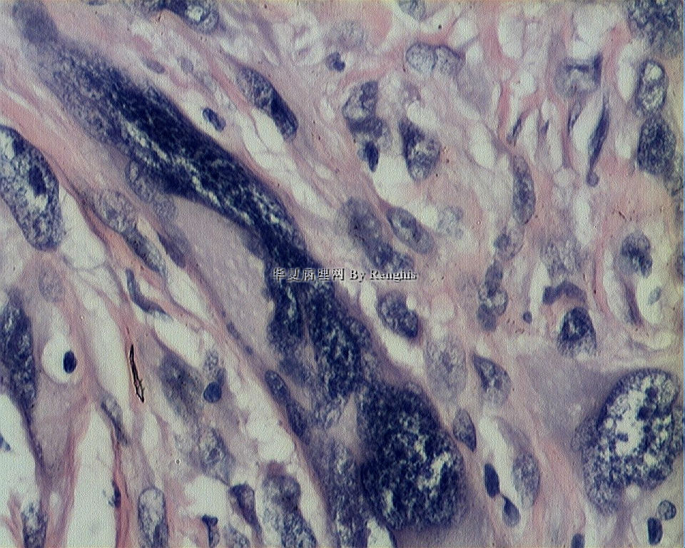 左大腿内侧肿物图11