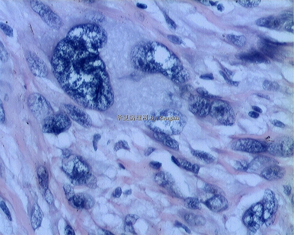 左大腿内侧肿物图12