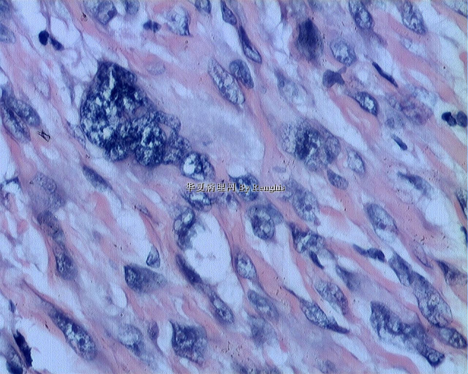 左大腿内侧肿物图13