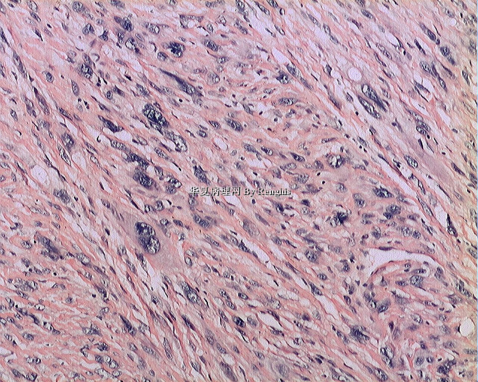 左大腿内侧肿物图14