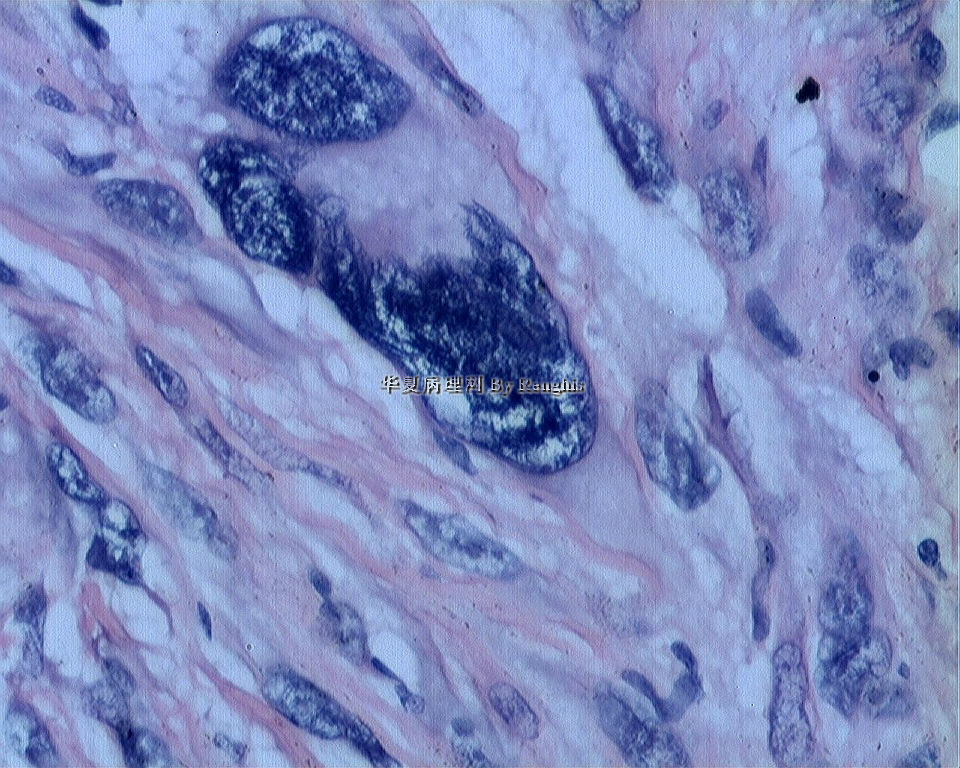 左大腿内侧肿物图15