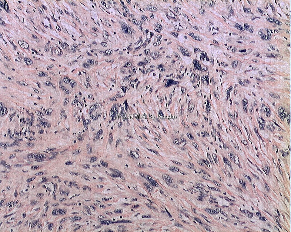 左大腿内侧肿物图17