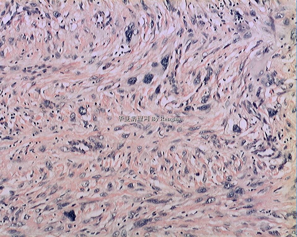 左大腿内侧肿物图18