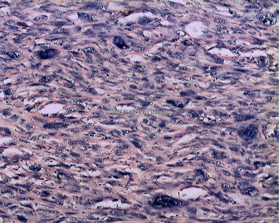 左大腿内侧肿物图19