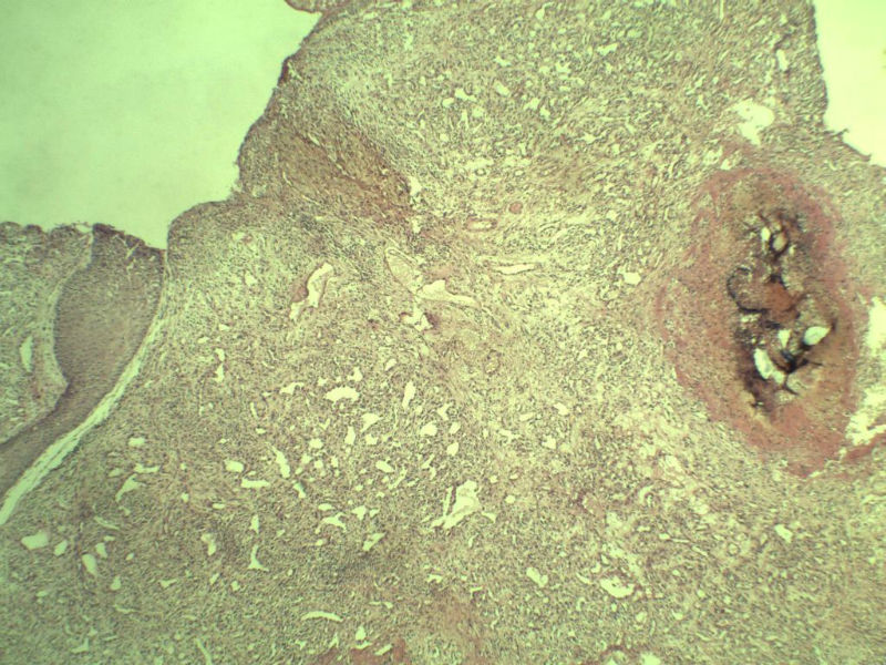食指赘生物图2 食指赘生物图2