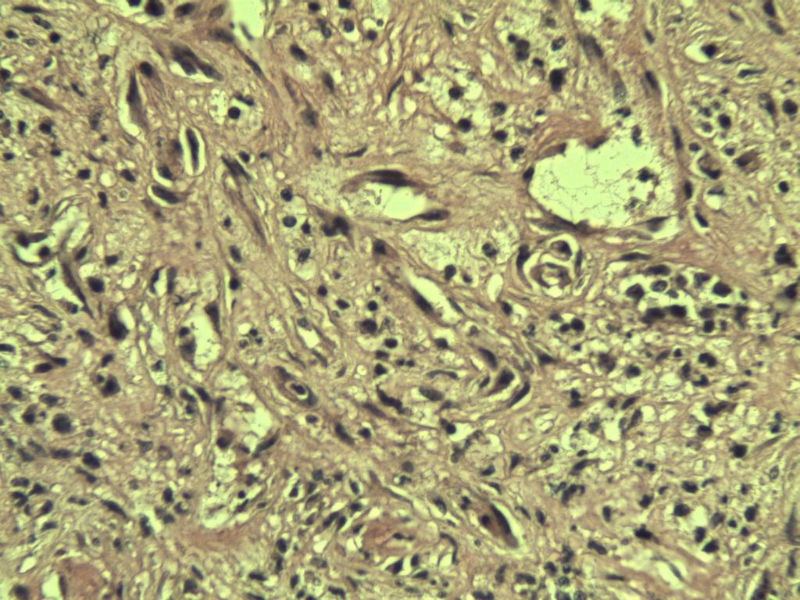 食指赘生物图16 食指赘生物图16