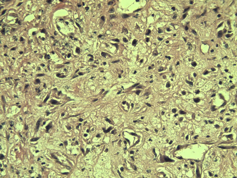 食指赘生物图17 食指赘生物图17