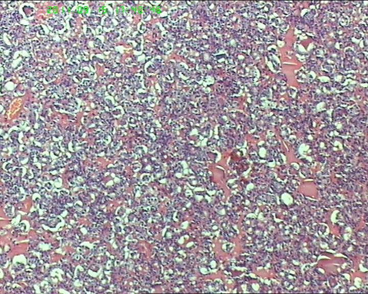 38岁女性甲状腺，腺瘤？滤泡癌？图7