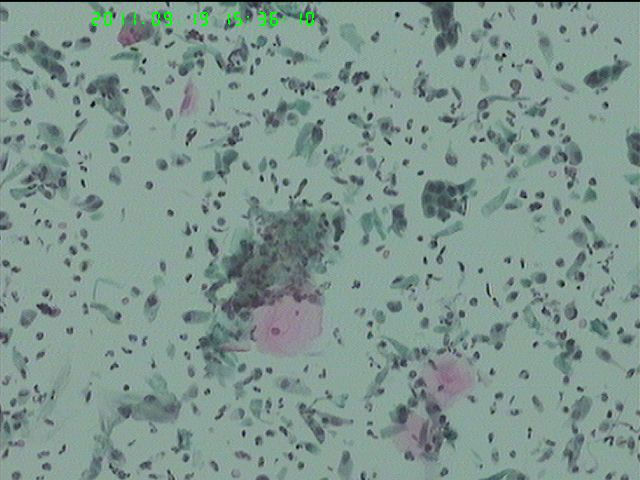 LCT再来一例图11